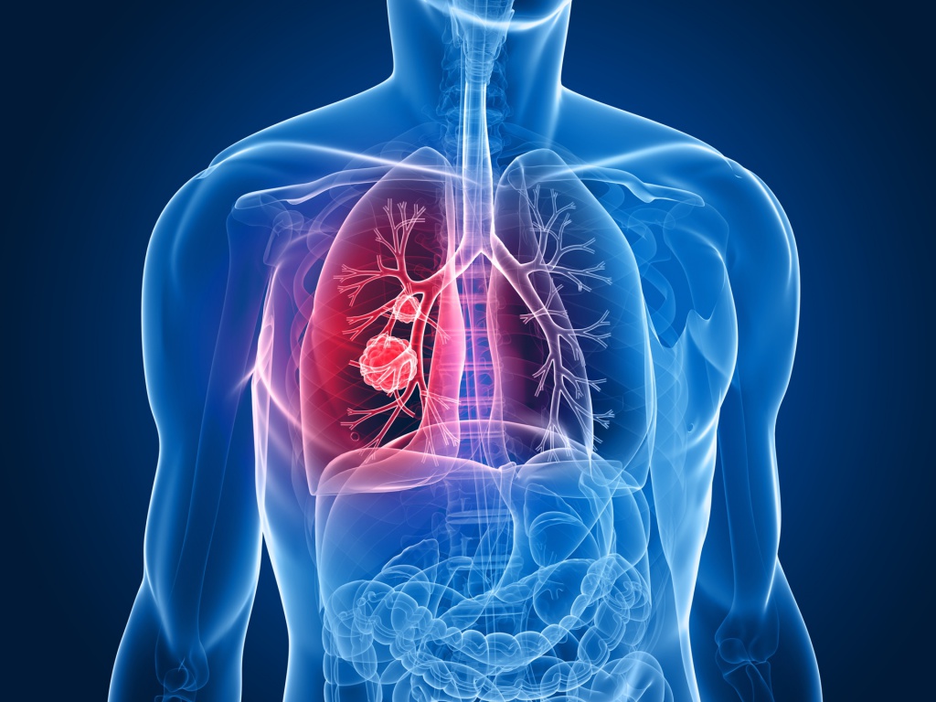 an analysis of the lung cancer effects symptoms and prevention for the disease an analysis of the lung cancer effects symptoms and prevention for the disease